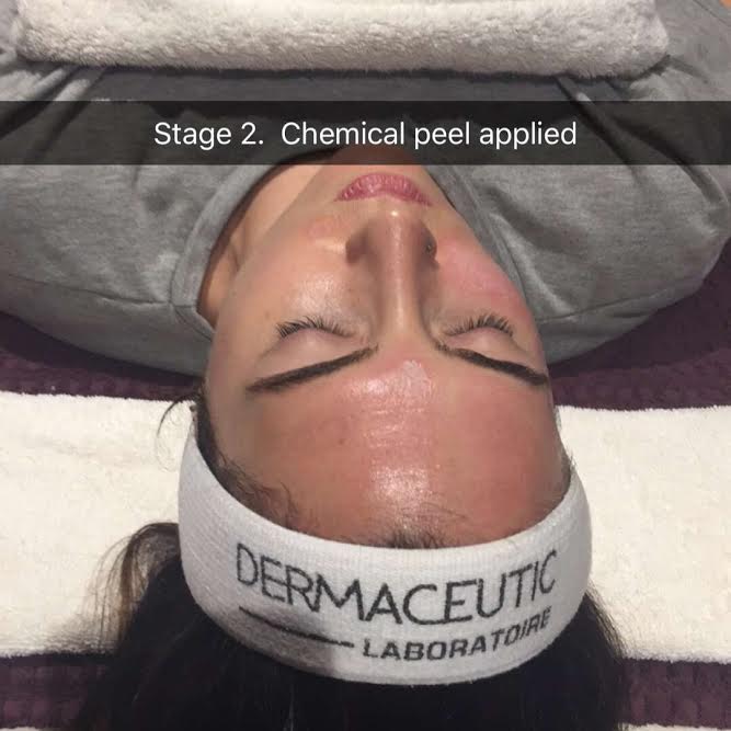 Stage 2- Chemical Peel 